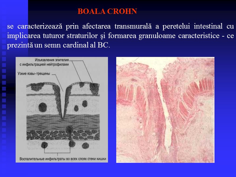 BOALA CROHN se caracterizează prin afectarea transmurală a peretelui intestinal cu implicarea tuturor straturilor